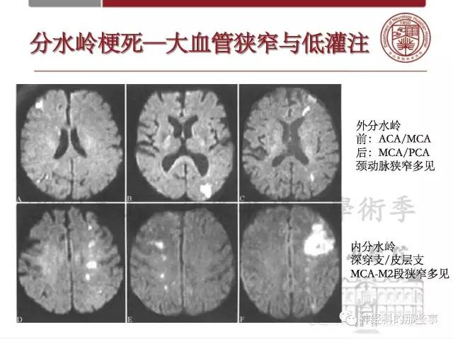 【PPT】脑血管病的影像诊断基础