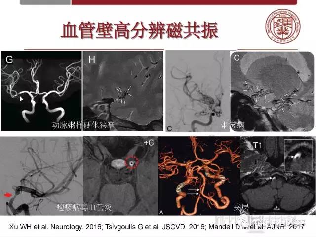 【PPT】脑血管病的影像诊断基础
