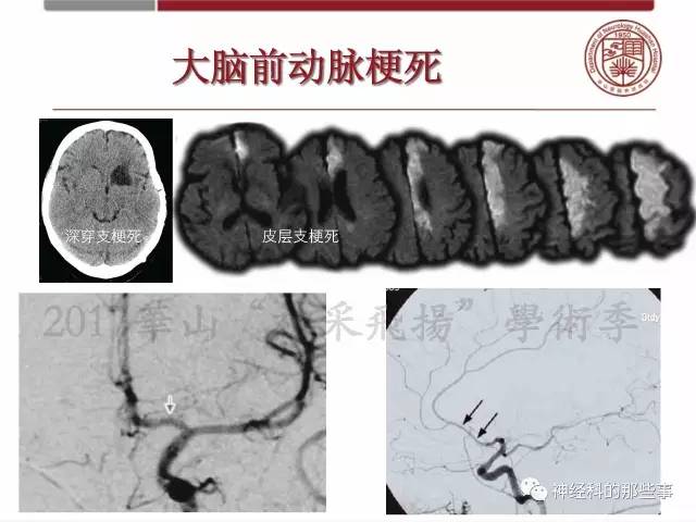 【PPT】脑血管病的影像诊断基础
