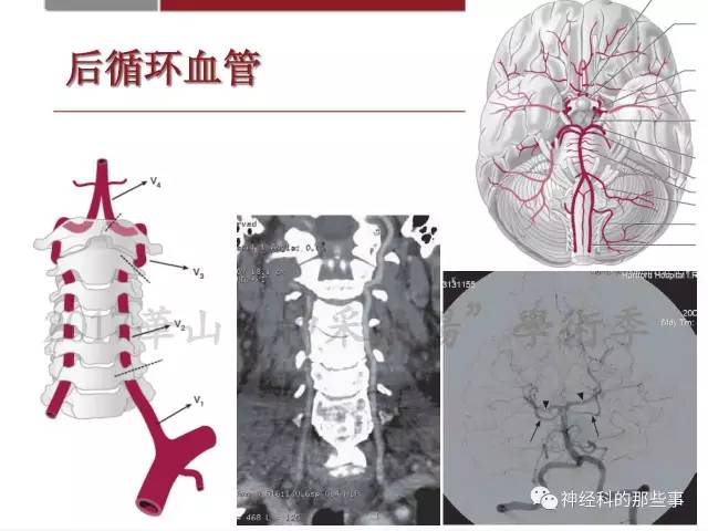 【PPT】脑血管病的影像诊断基础