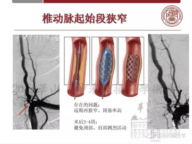 【PPT】脑血管病的影像诊断基础