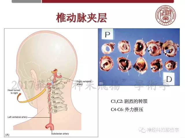 【PPT】脑血管病的影像诊断基础