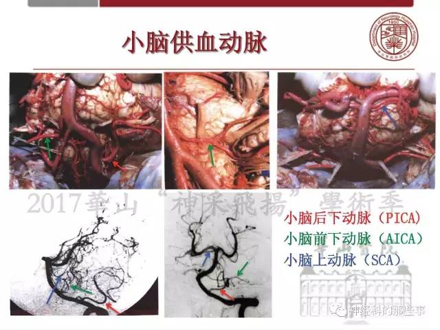 【PPT】脑血管病的影像诊断基础