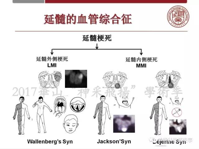 【PPT】脑血管病的影像诊断基础