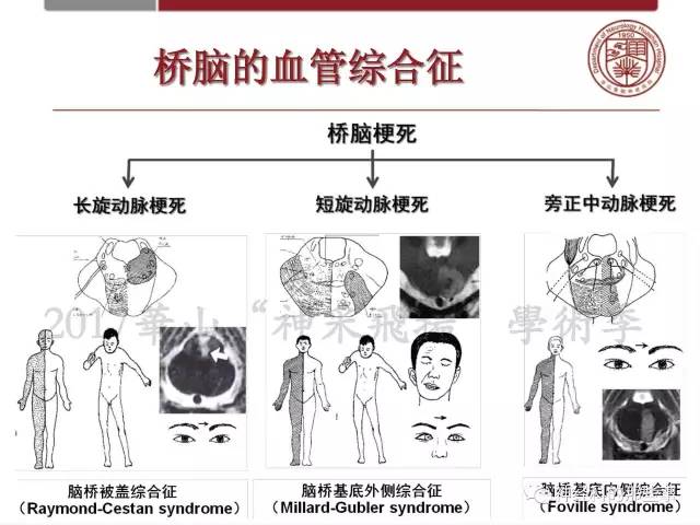 【PPT】脑血管病的影像诊断基础