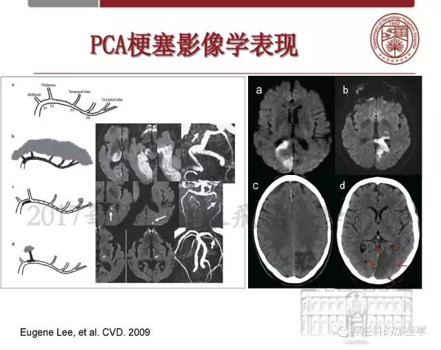 【PPT】脑血管病的影像诊断基础