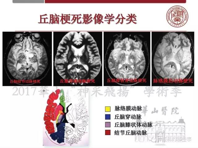 【PPT】脑血管病的影像诊断基础