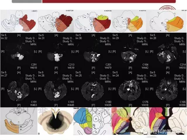 【PPT】脑血管病的影像诊断基础