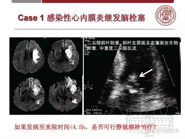 【PPT】脑血管病的影像诊断基础