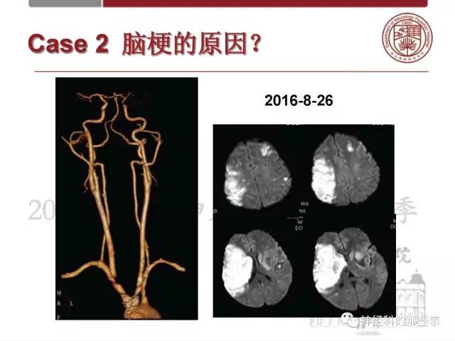 【PPT】脑血管病的影像诊断基础