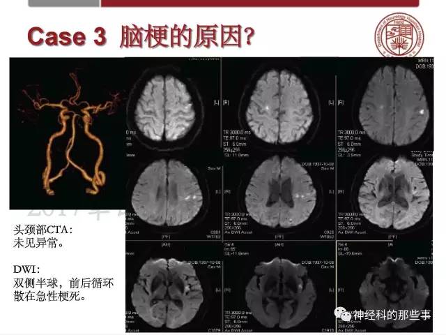 【PPT】脑血管病的影像诊断基础