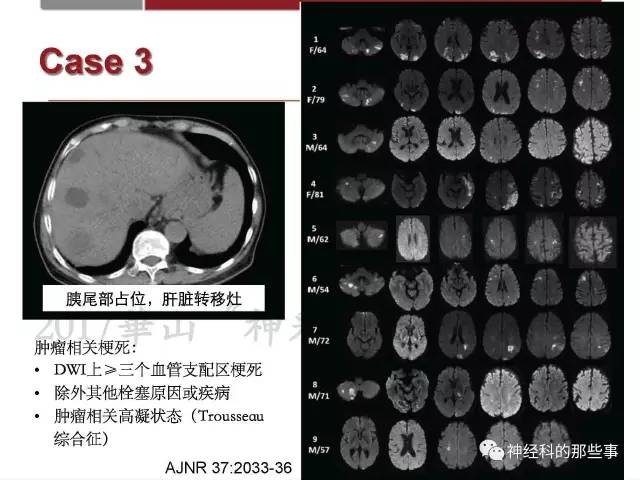 【PPT】脑血管病的影像诊断基础