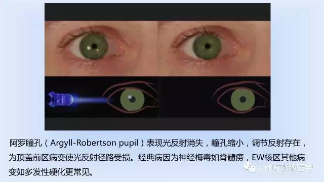【PPT】神经梅毒的影像诊断