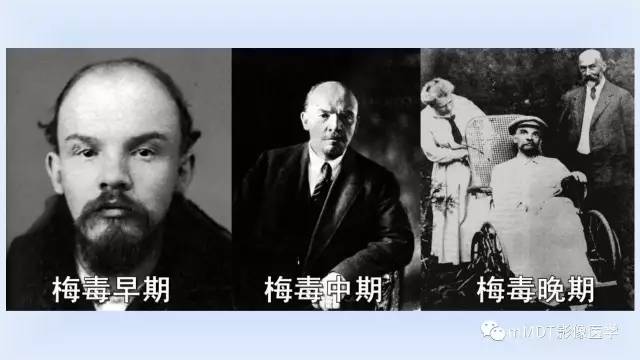 【PPT】神经梅毒的影像诊断
