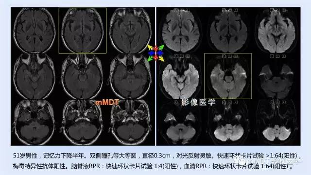 【PPT】神经梅毒的影像诊断
