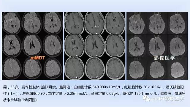 【PPT】神经梅毒的影像诊断
