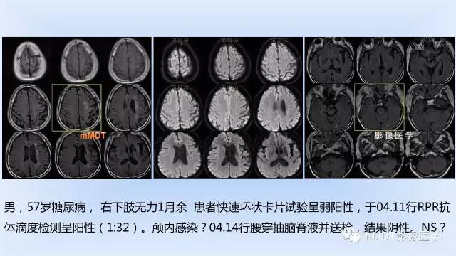 【PPT】神经梅毒的影像诊断