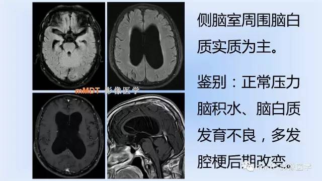 【PPT】神经梅毒的影像诊断