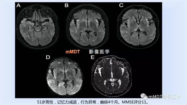 【PPT】神经梅毒的影像诊断
