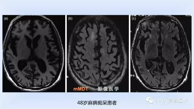 【PPT】神经梅毒的影像诊断