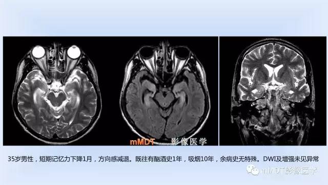 【PPT】神经梅毒的影像诊断