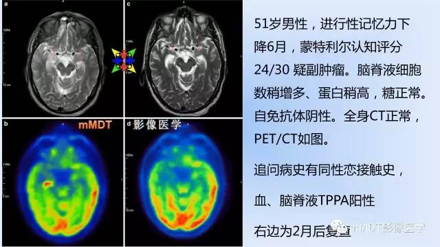 【PPT】神经梅毒的影像诊断