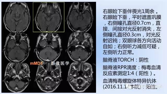 【PPT】神经梅毒的影像诊断