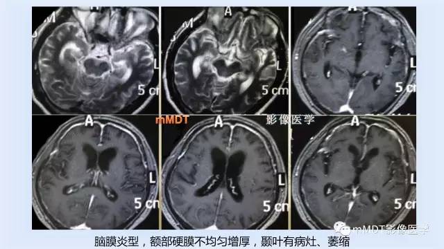 【PPT】神经梅毒的影像诊断