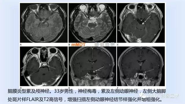 【PPT】神经梅毒的影像诊断