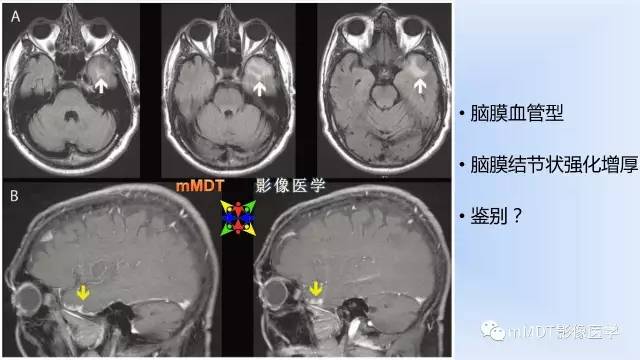 【PPT】神经梅毒的影像诊断