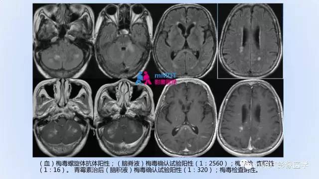 【PPT】神经梅毒的影像诊断