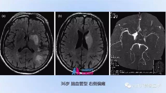 【PPT】神经梅毒的影像诊断