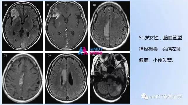 【PPT】神经梅毒的影像诊断