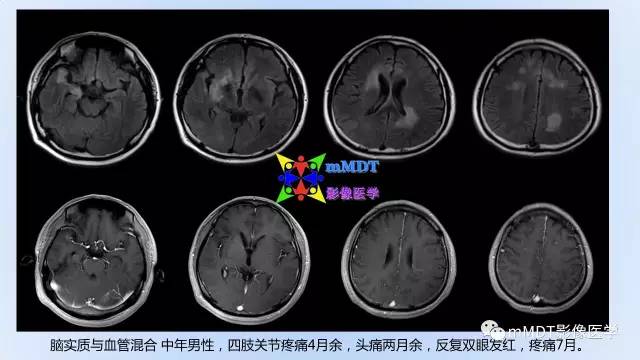【PPT】神经梅毒的影像诊断