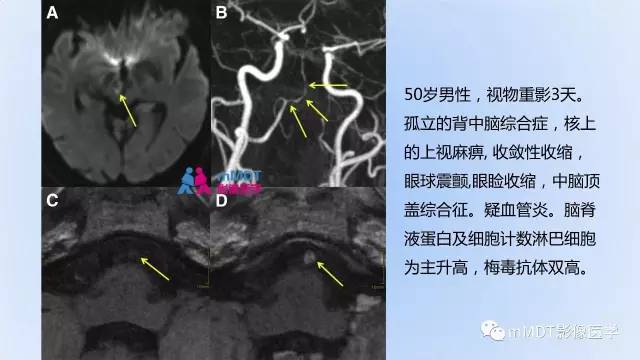 【PPT】神经梅毒的影像诊断