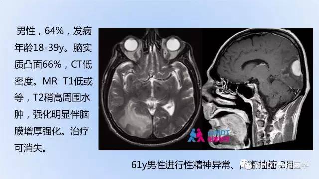 【PPT】神经梅毒的影像诊断