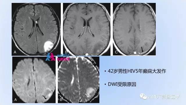 【PPT】神经梅毒的影像诊断