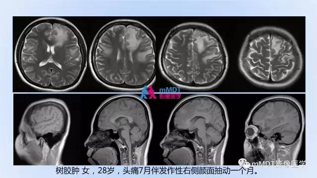 【PPT】神经梅毒的影像诊断
