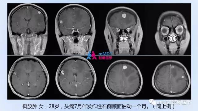 【PPT】神经梅毒的影像诊断
