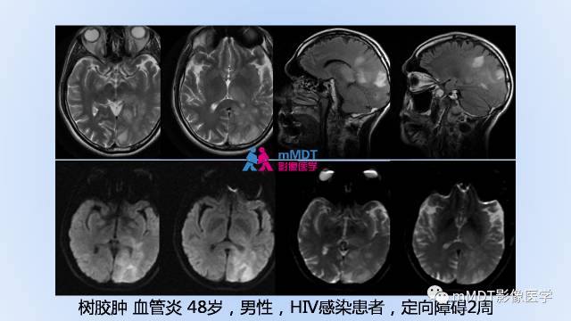 【PPT】神经梅毒的影像诊断
