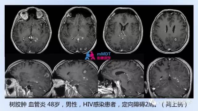 【PPT】神经梅毒的影像诊断