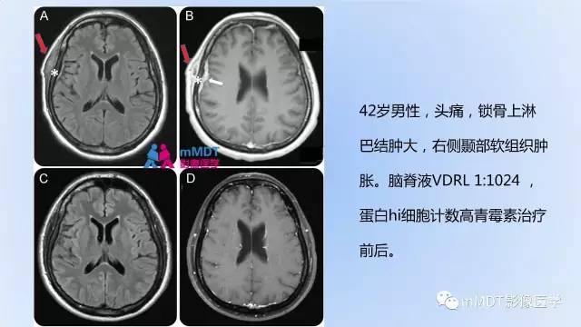 【PPT】神经梅毒的影像诊断