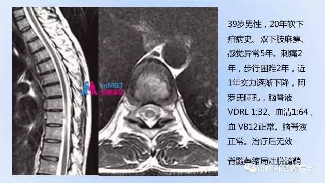 【PPT】神经梅毒的影像诊断