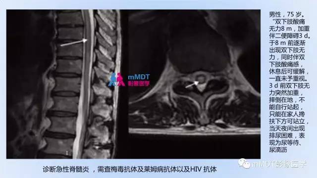 【PPT】神经梅毒的影像诊断