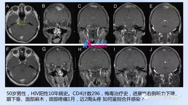 【PPT】神经梅毒的影像诊断
