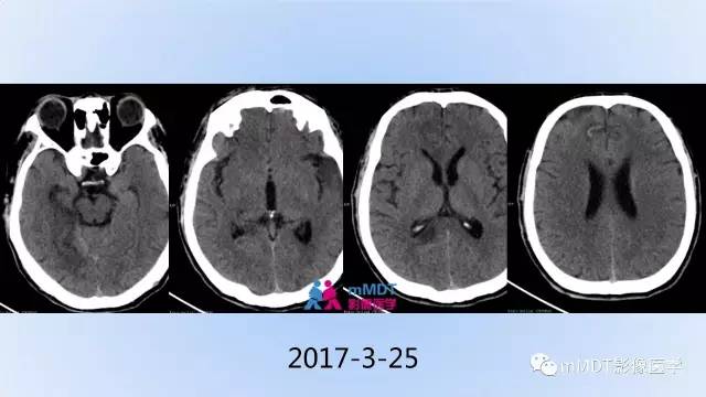 【PPT】神经梅毒的影像诊断