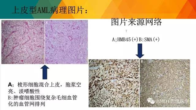 【PPT】肾血管平滑肌脂肪瘤影像表现