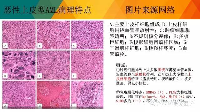 【PPT】肾血管平滑肌脂肪瘤影像表现