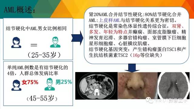 【PPT】肾血管平滑肌脂肪瘤影像表现