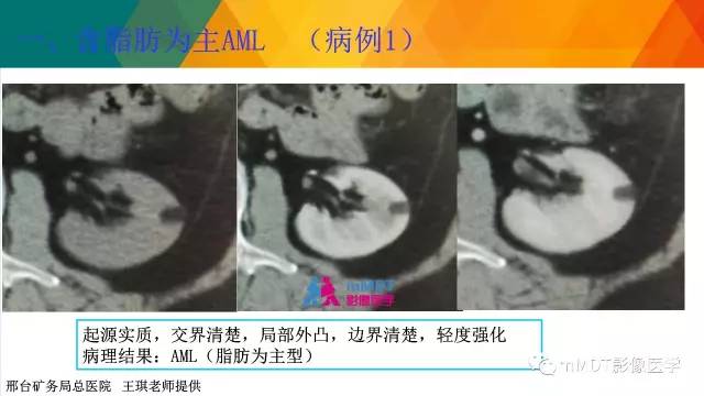 【PPT】肾血管平滑肌脂肪瘤影像表现